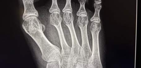 В Елецкой детской больнице проведена сложная операция 17-летней пациентке с детским церебральным параличом